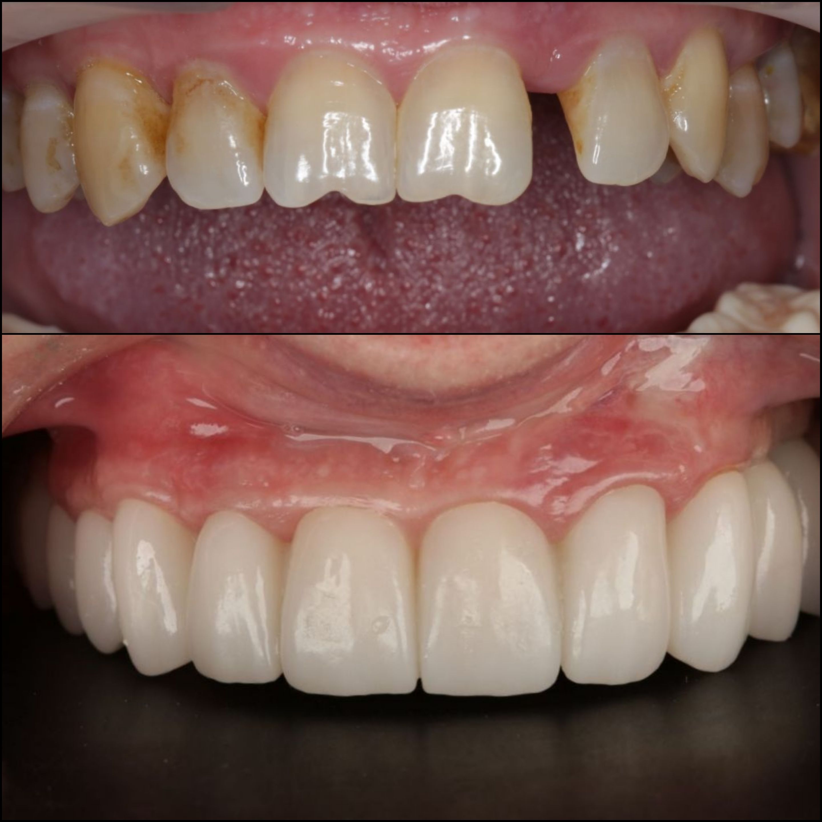 Тотальная реабилитация зубов циркониевыми коронками и винирами